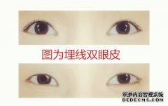關(guān)于埋線法雙眼皮好不好？怎么樣的分析及案例