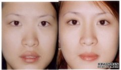 自體脂肪隆鼻相比假體隆鼻好不好？怎么樣？