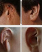 上海九院張如鴻做耳再造好不好，有案例圖嗎