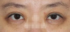 在成都做的雙眼皮修復案例，大家看看如何？
