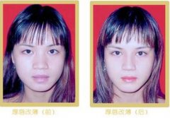 厚嘴唇改薄手術(shù)有風(fēng)險嗎？