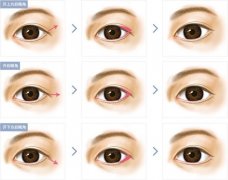 在北京開眼角需要多少錢？