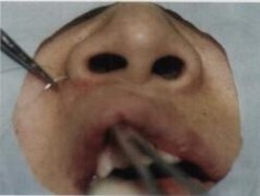鼻底縮小術(shù)的簡(jiǎn)單介紹