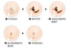 早期的乳房縮小整形手術是怎樣的呢？