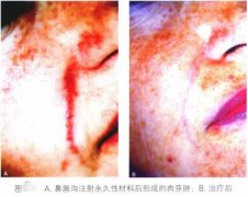 美女們，你們真敢去工作室注射玻尿酸嗎