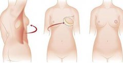 乳房外形可以再塑造嗎？