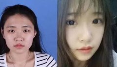 分享幾家整形醫(yī)院的眼部整形案例