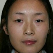 西安做的雙眼皮+假體隆鼻+隆下巴+自體脂肪填充