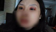 爆料，張女士的雙眼皮是怎么了？
