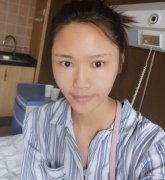 廣州做的全臉脂肪填充，果蠻不錯(cuò)的。