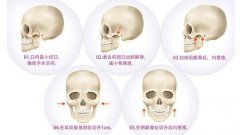 做顴骨內(nèi)推有后遺癥嗎？術(shù)后注意事項(xiàng)？