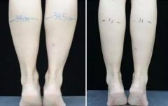 注射注射瘦腿果怎么樣？哪種品牌好？