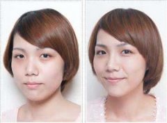 如果用自體脂肪填充淚溝，術(shù)后需要注意什么？