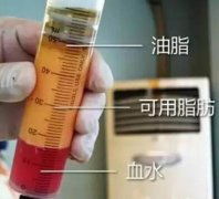 抽脂、移植術(shù)后的恢復(fù)以及護理