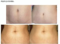 祛妊娠紋有辦法嗎？