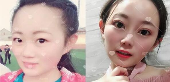 武漢華美做雙眼皮好嗎?需要多少錢?