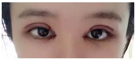 做了雙眼皮+開眼角，我也是萌妹子了!