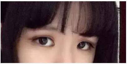 做了雙眼皮+開眼角，我也是萌妹子了!