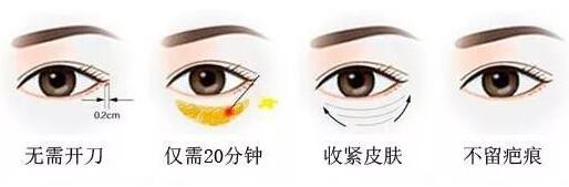 內(nèi)切祛眼袋