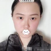 亞韓整形美容醫(yī)院假體隆鼻案例，顏值蛻變記