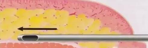 面部脂肪填充的基本原理