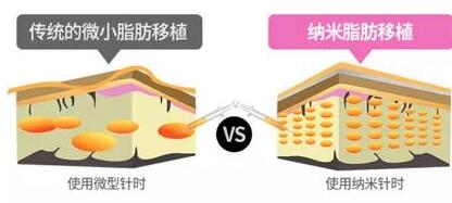 面部脂肪填充的基本原理