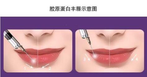 膠原蛋白豐唇手術(shù)原理介紹
