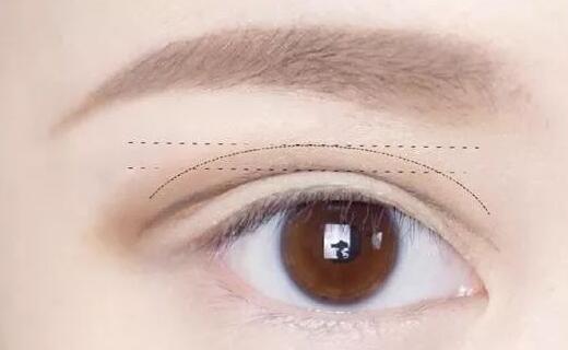 做雙眼皮手術(shù)疼嗎?