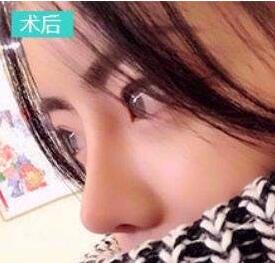 鼻整形的作用有什么?