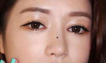 膨體隆鼻假體晃動(dòng)這樣的情況是否正常呢?