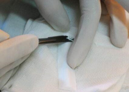 膨體隆鼻假體晃動(dòng)是不是說明了手術(shù)失敗呢?