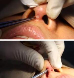 做膨體隆鼻的話，假感會戳穿鼻頭?