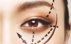 關(guān)于自體脂肪填充淚溝恢復(fù)期注意事項的那些事