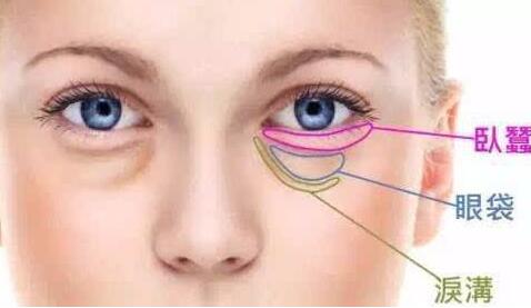 自體脂肪填充淚溝恢復期有哪些注意事項?