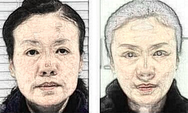 關于自體脂肪填充的一些疑問解答