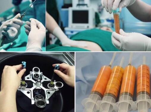 關于自體脂肪填充的一些疑問解答