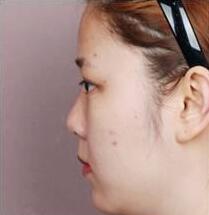 不同的隆鼻方式適合不同鼻部基礎(chǔ)的人群