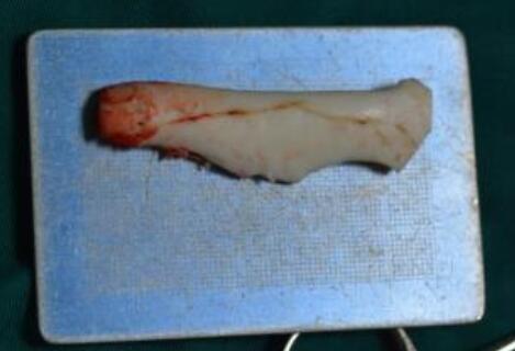 不同的隆鼻方式適合不同鼻部基礎(chǔ)的人群