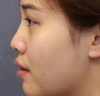 不同的隆鼻方式適合不同鼻部基礎(chǔ)的人群