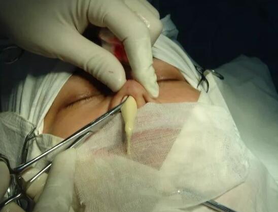 硅膠隆鼻假體明X有什么補(bǔ)救措施嗎?