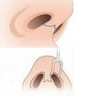 鼻整形手術(shù)的創(chuàng)口挑選