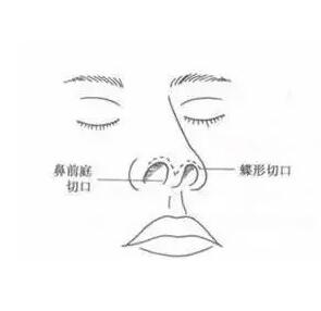 鼻整形手術(shù)的創(chuàng)口挑選