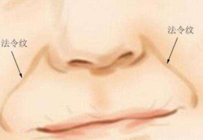 法令紋自體脂肪可以填充嗎？這個技術(shù)好嗎？