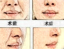 自體脂肪可以填充法令紋嗎?這個技術(shù)好嗎?