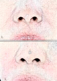 自體脂肪填充法令紋有哪些優(yōu)勢呢?