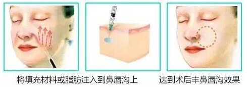 自體脂肪填充法令紋有哪些優(yōu)勢呢?