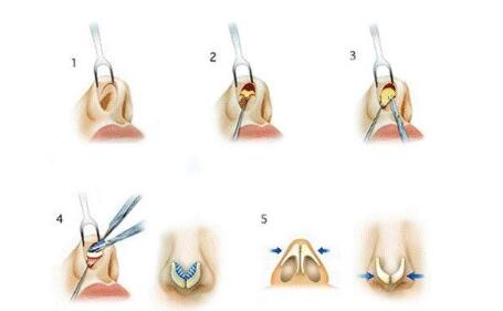 什么是膨體隆鼻手術(shù)?