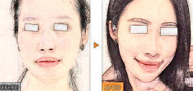 危害膨體隆鼻固定要素