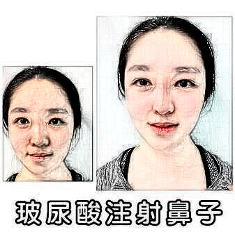 注射隆鼻的手術(shù)果