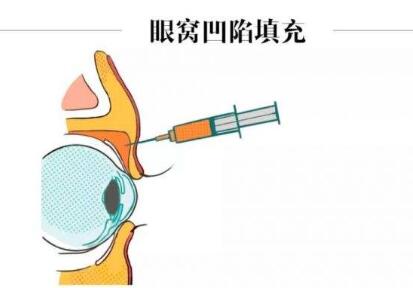 眼窩自體脂肪填充大概要多少錢?